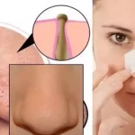 Siyah Noktalardan Kurtulmanın En Etkili Yolları