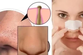 Siyah Noktalardan Kurtulmanın En Etkili Yolları