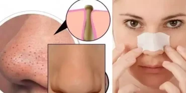 Siyah Noktalardan Kurtulmanın En Etkili Yolları