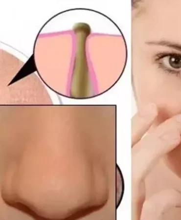 Siyah Noktalardan Kurtulmanın En Etkili Yolları