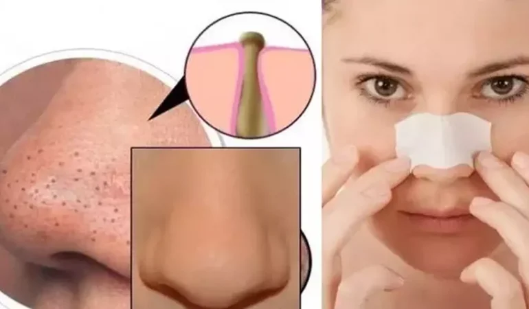 Siyah Noktalardan Kurtulmanın En Etkili Yolları